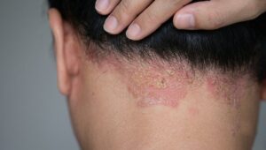Dermatita seboreică: cauze, simptome și opțiuni de tratament